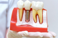 Имплантация зубов - «КАРАТ» - 
