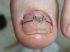 Ногти врастают и причиняют боль: почему каждому стоит посетить подолога 