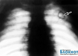 Туберкулез у волгодонцев выявляют каждые пять дней