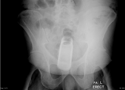 Волгодонца госпитализировали с дезодорантом в анусе