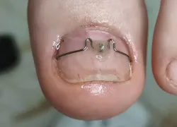 Ногти врастают и причиняют боль: почему каждому стоит посетить подолога 