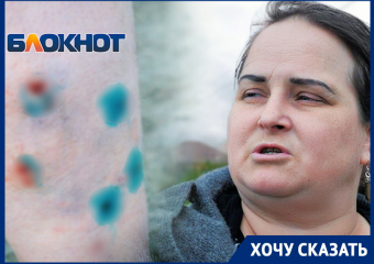 Ужас и дикая боль: дважды за неделю на волгодончанку напали бездомные псы