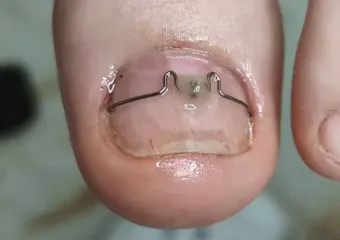 Ногти врастают и причиняют боль: почему каждому стоит посетить подолога 