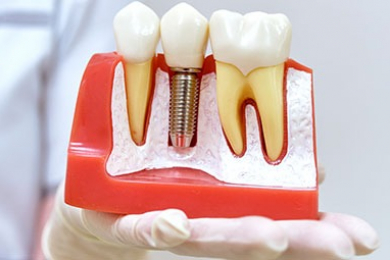 Имплантация зубов - «КАРАТ»