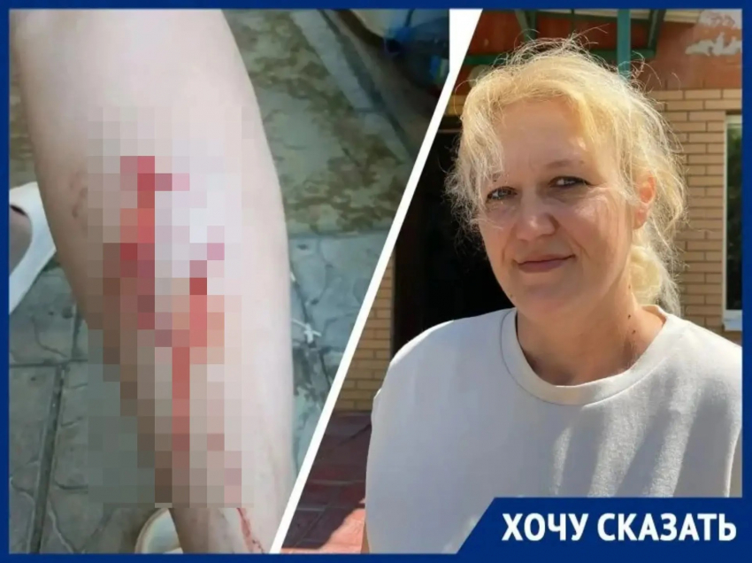 «Кровь не могли остановить два часа»: чипированная собака чуть не отгрызла ногу матери троих детей в Волгодонске  
