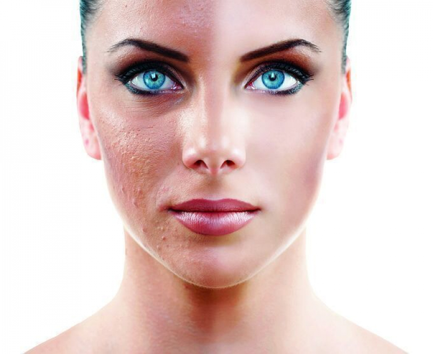 Внимание! Сезон пилингов и Лазера СО2 заканчивается!