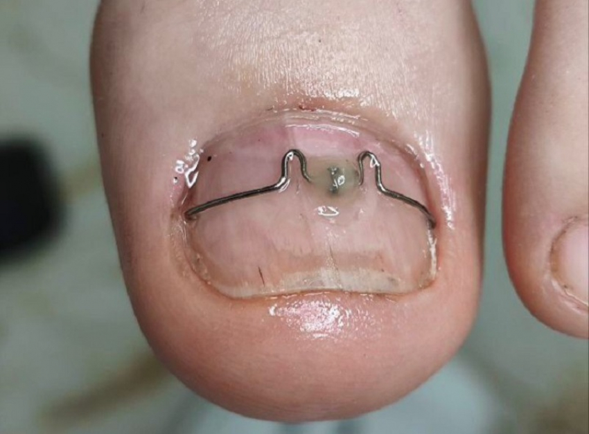 Ногти врастают и причиняют боль: почему каждому стоит посетить подолога 